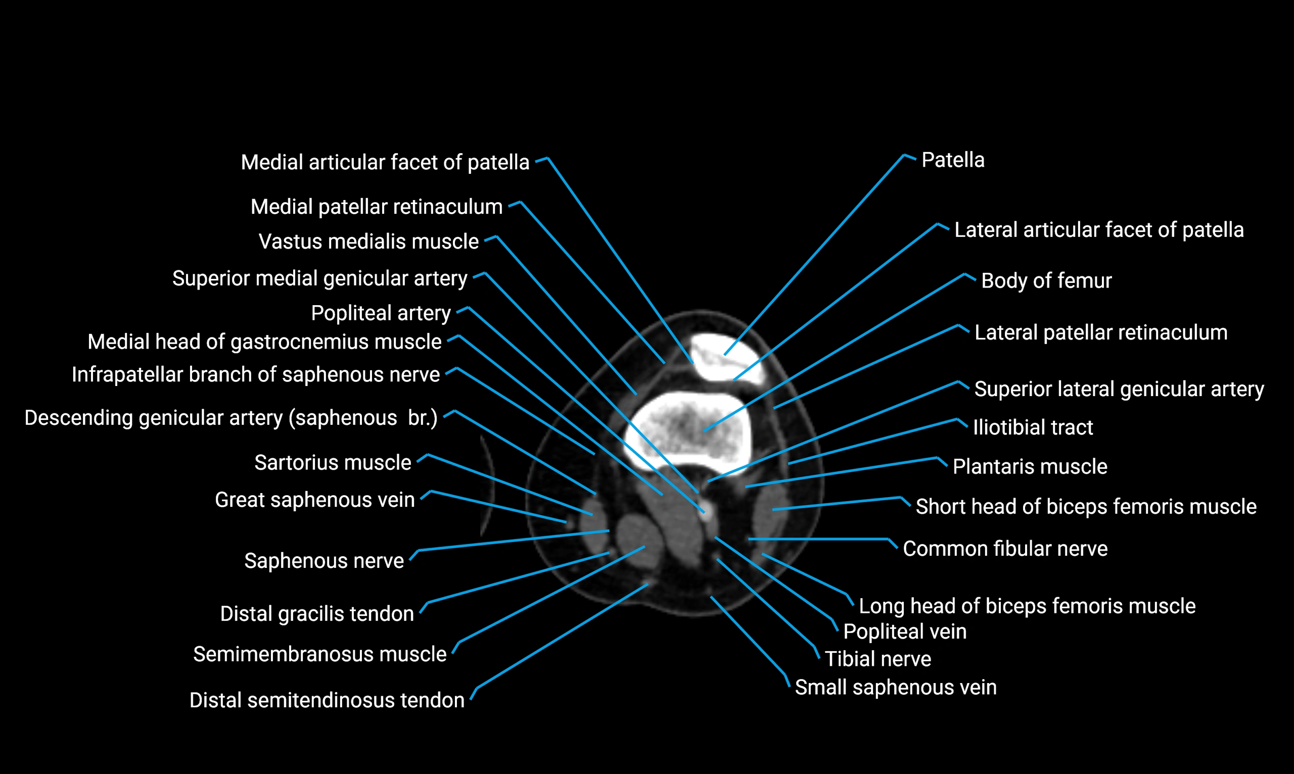 CT thigh axial cross sectional anatomy labelled image_81 (2).webp